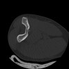 SPORK, NICO - 22.03.1976 - 02.08.2022 - CT obere Extremität - 17:51:17